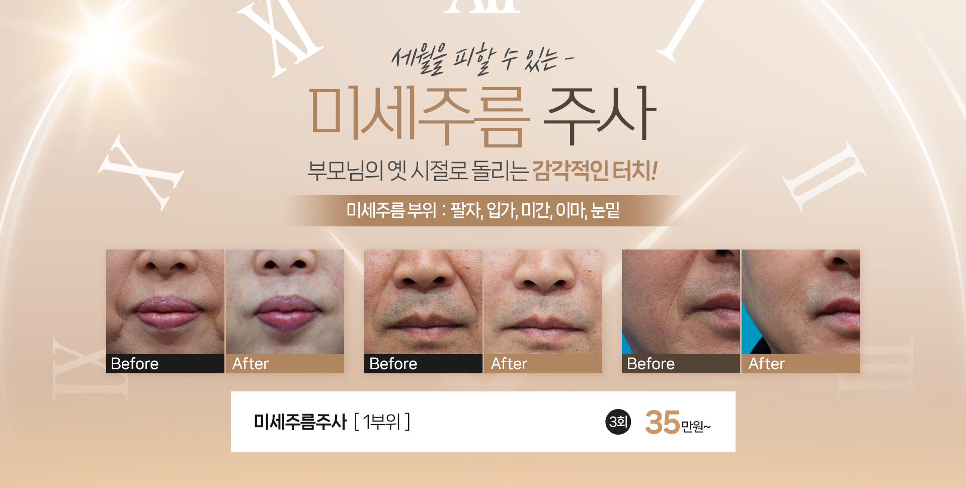 미세주름필러