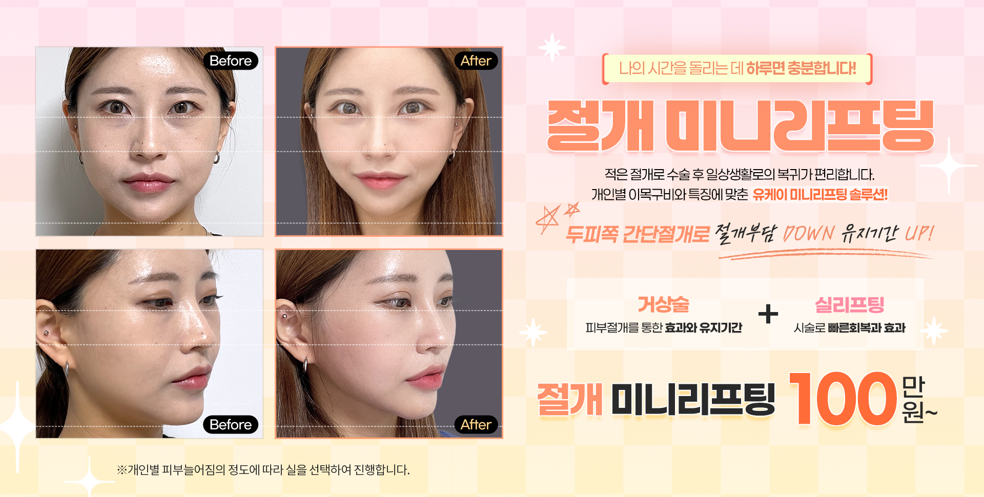 절개미니리프팅