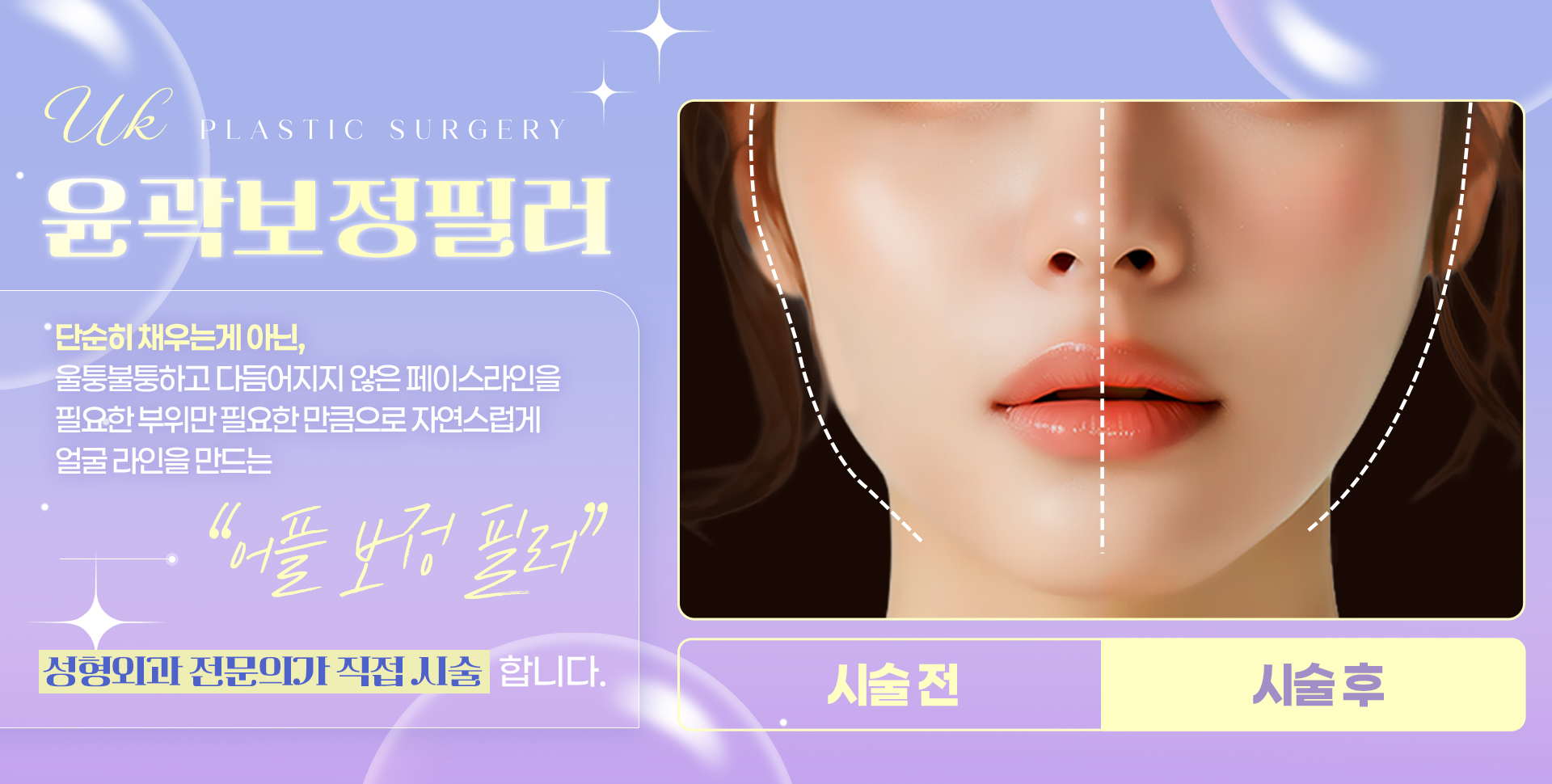 윤곽보정필러